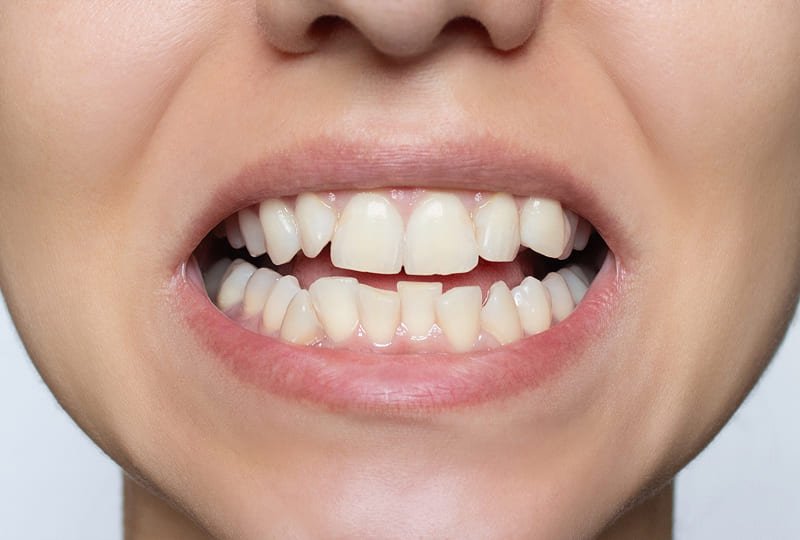 Antes: Ana Luísa, 28 anos - São Paulo/SP