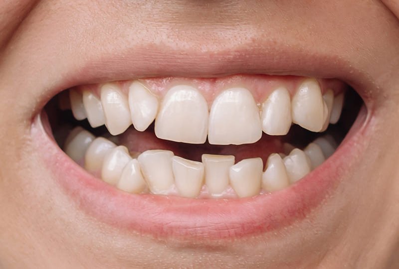 Antes: Juliana Ribeiro, 25 anos - Curitiba/PR