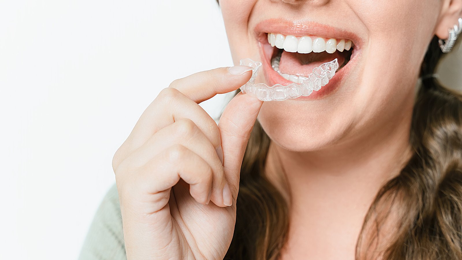 Alinhadores invisíveis SkyAligner - Transforme seu sorriso