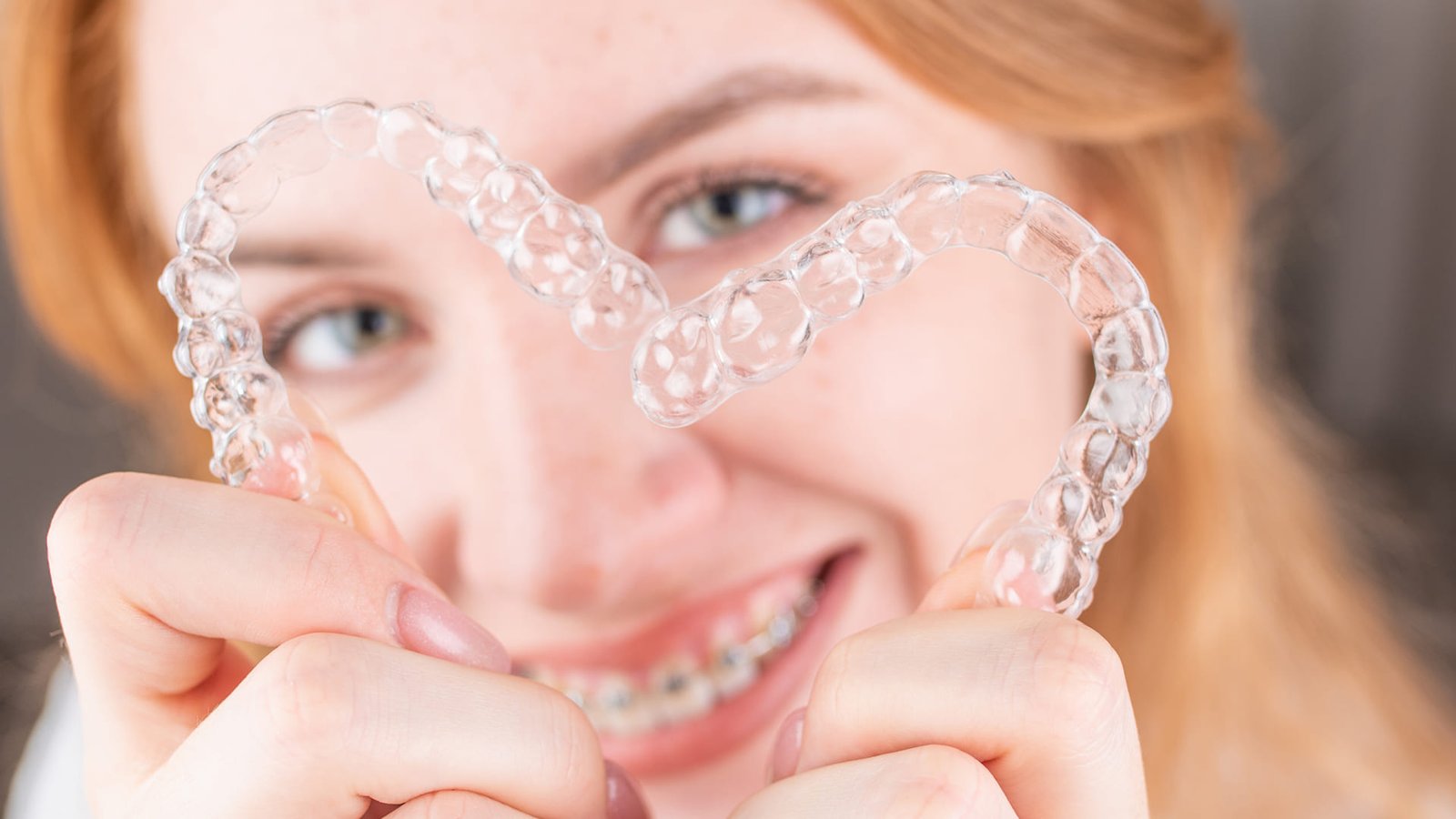 5 motivos para escolher alinhadores invisíveis no lugar do aparelho fixo